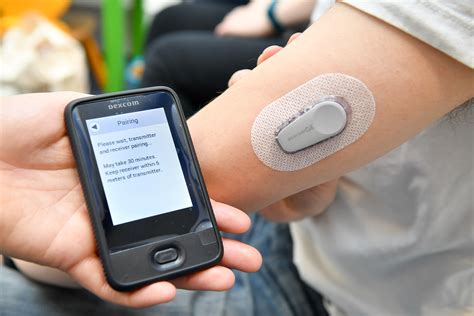 dexcom cgm.